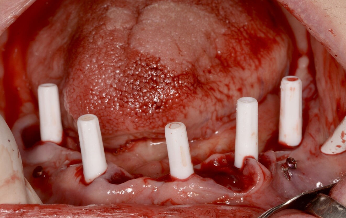 Fig. 5: Intra-op photograph after attachment of the osteosynthesis screws and implant placement.