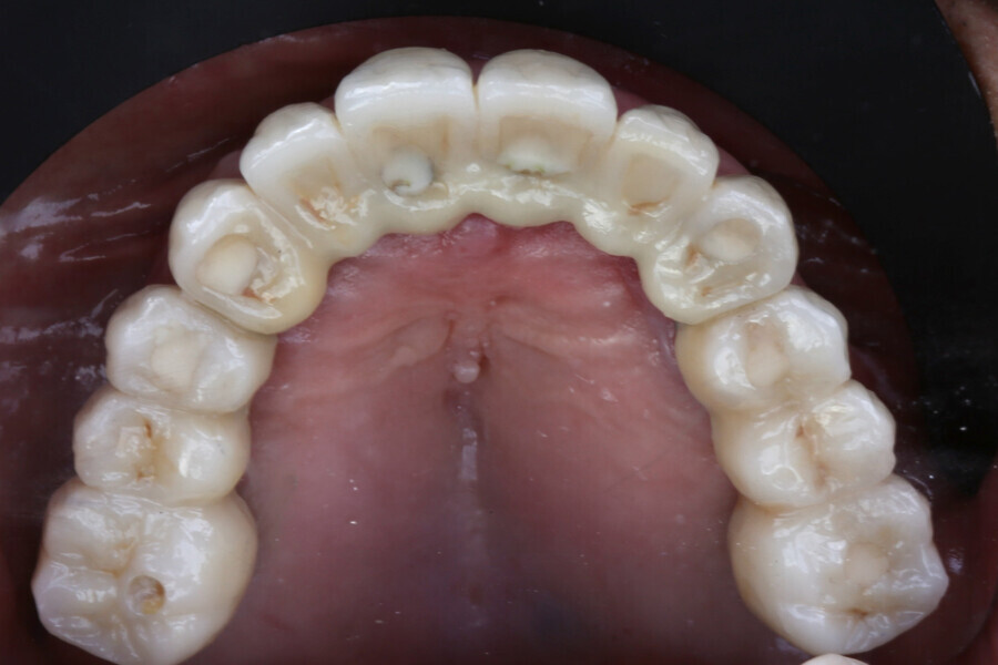 Fig. 20: Definitive prosthesis at the one-year follow-up, occlusal view.