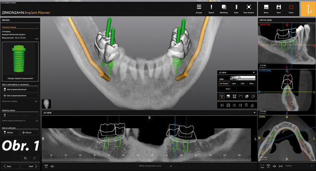 Plánování pozice implantátu pomocí dat DICOM a předem zhotovené postavení zubů v oblastech 36, 35, 45 a 46. Prohlížení rentgenových snímků po jednotlivých vrstvách pomáhá při zohlednění kostních struktur s nalezením nejlepší možné pozice implantátu z estetického a funkčního hlediska.