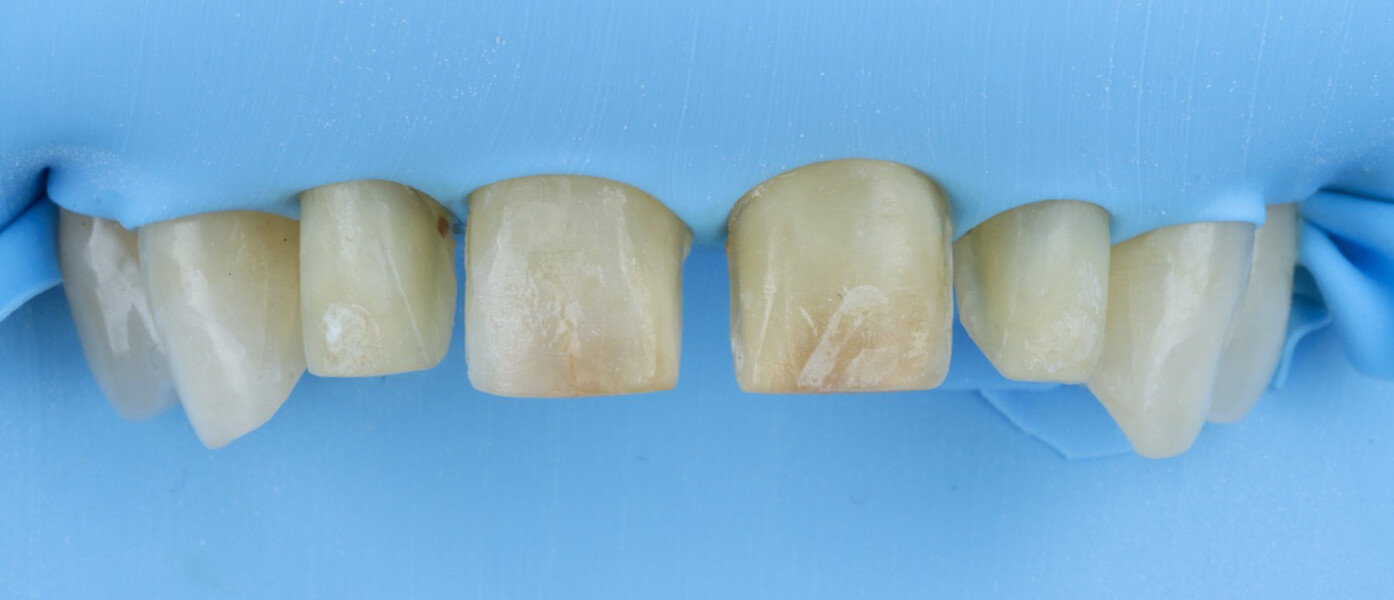 Fig. 12: Dental dam isolation using Isodam HD.