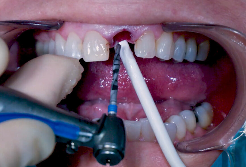 Fig. 6: Osteotomy with Ø 2.2 mm
drill.