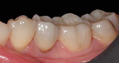 Daily aesthetic dentistry: The contribution of the spectrophotometer