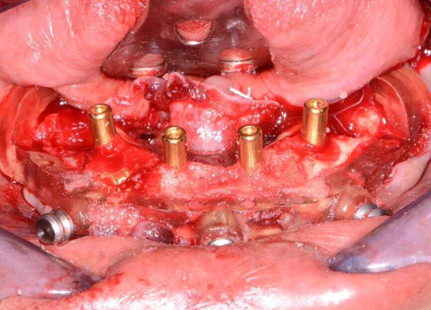 Fig. 16: Overdenture attachments inserted, followed by grafting material.