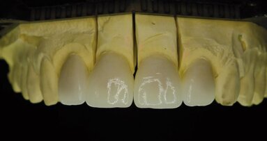 Disilicate de lithium – Une solution efficace pour les cas exigeants de la chirurgie esthétique