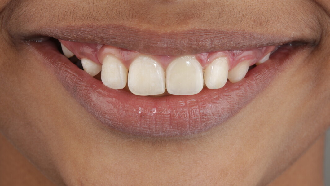 Fig 40: Life-like appeal to final restoration.