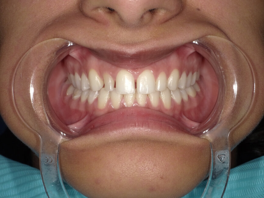 Fig 4: Retracted view after removal of old restorations