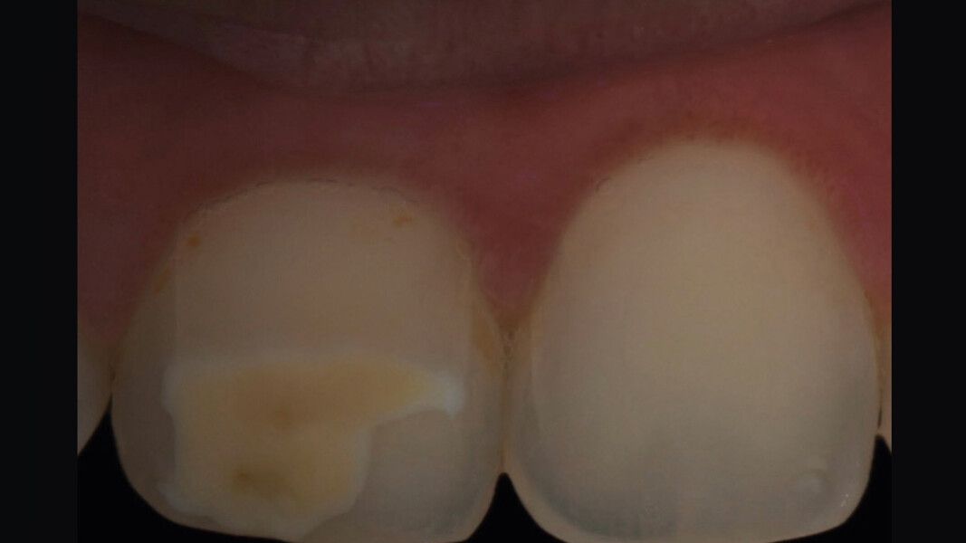Fig. 3 - Visuale con filtro polarizzato, che consente di apprezzare meglio la diffusione e la profondità della lesione.