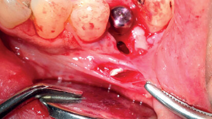 Ruolo del collare in zirconio nella gestione della perimplantite: case report