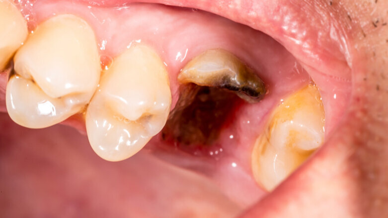 Poor oral health associated with a higher risk of liver cancer, study suggests