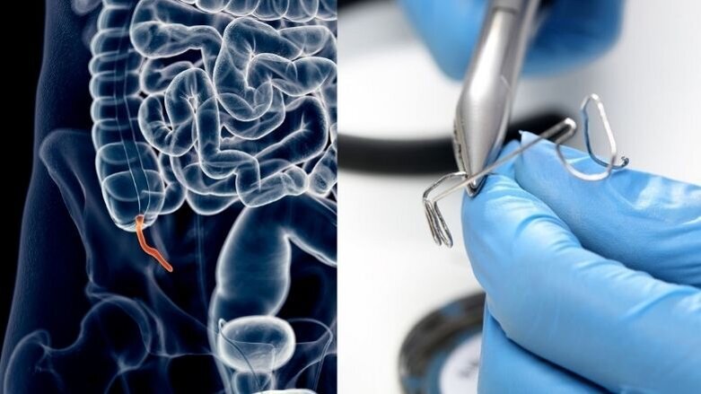 Blindedarmontsteking door orthodontische draad