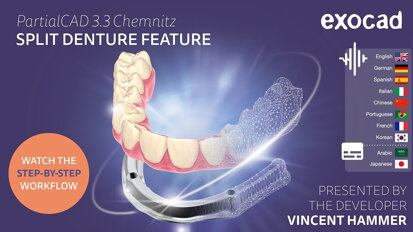 exocad – PartialCAD 3.3 Chemnitz - Split denture feature