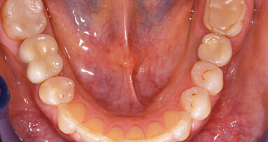 Long-Term Clinical Success with the Neoss Implant System: A Case Report