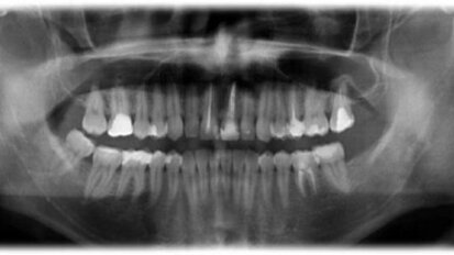 Leczenie endodontyczne autogennego przeszczepu zęba z zastosowaniem lasera Er,Cr:YSGG