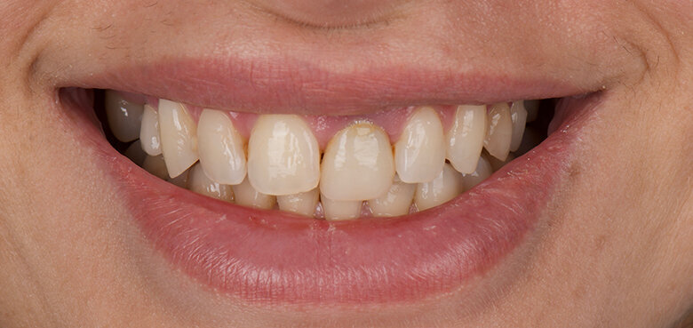 Fig. 16: Pre-op clinical view showing a greyish fractured tooth #21.