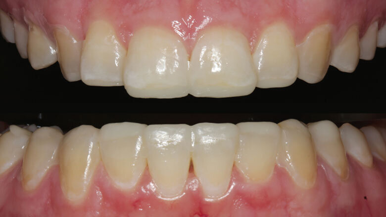 Figure 4:  Mock-up made of provisional composite resin