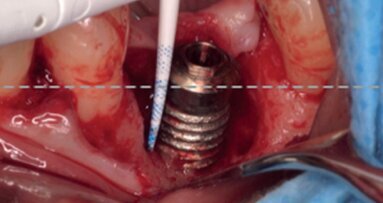 Surgical treatment of circumferential and semicircumferential defects due to periimplantitis: A prospective case series cohort study