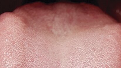 La IADR elogia las campañas de cáncer oral en España