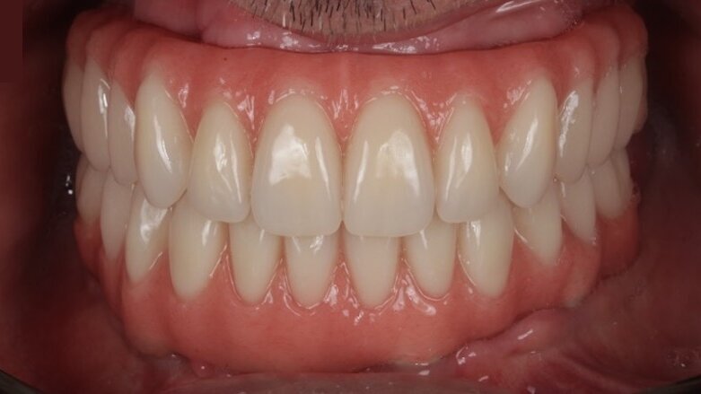 PEEK implant-supported prostheses to be discussed in webinar