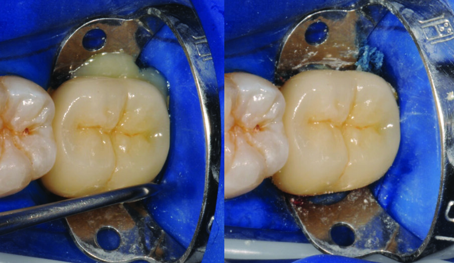Fig. 13: Remove excess cement with a scaler.  (!)Tip: Hold the crown in place.