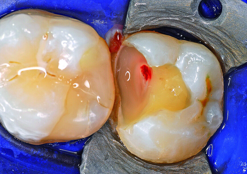 Fig. 16: After caries removal, the pulp was exposed.
