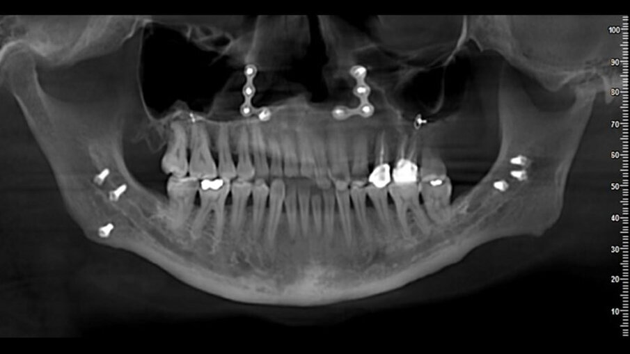 Fig. 3_Vista panoramica CBCT che mostra una grande discrepanza nelle dimensioni e nella morfologia tra i condili destro e sinistro e mostra un allargamento della testa e del collo sul lato destro.