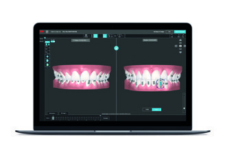 Solventum – 3M Digital Bonding Trays