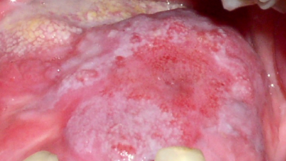 Sustancias coadyuvantes en el manejo de la mucositis oral