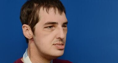 Възстановяването на пациента с трансплантирано лице надминава очакванията
