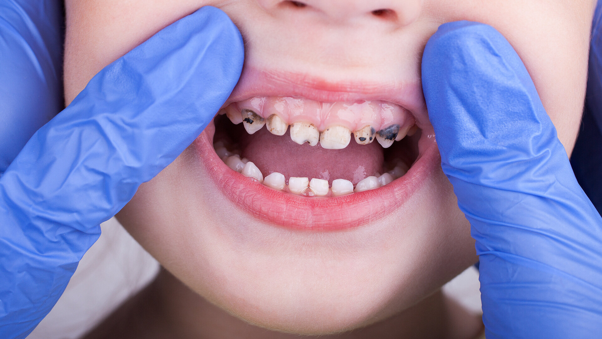 EFP reveals stunning global cost of gingivitis, caries, tooth loss