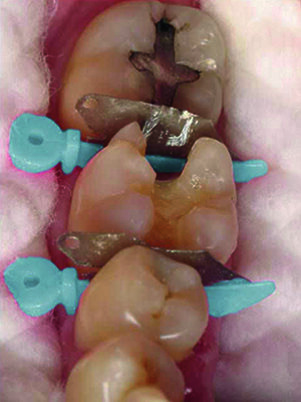 WedgeGuard protects adjacent tooth during preparation
