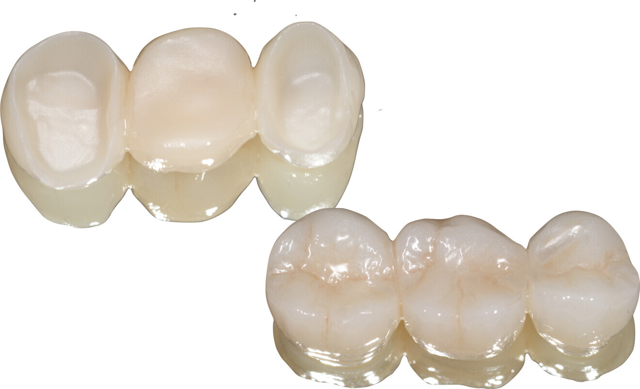 Fig. 5: Internal and external surfaces of the zirconia bridge.
