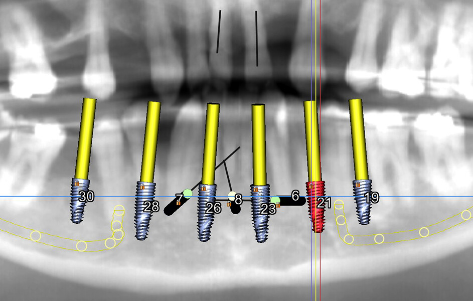 Fig. 6: Six simulated implants with three anchor pins in the mandible.