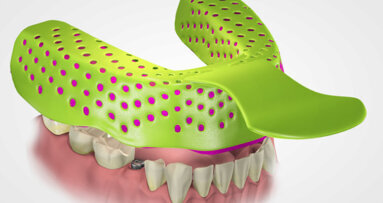 Study compares accuracy of open and closed implant impression techniques
