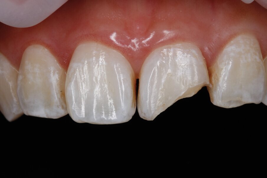 Fig 2: Pre-operative fractured upper left central