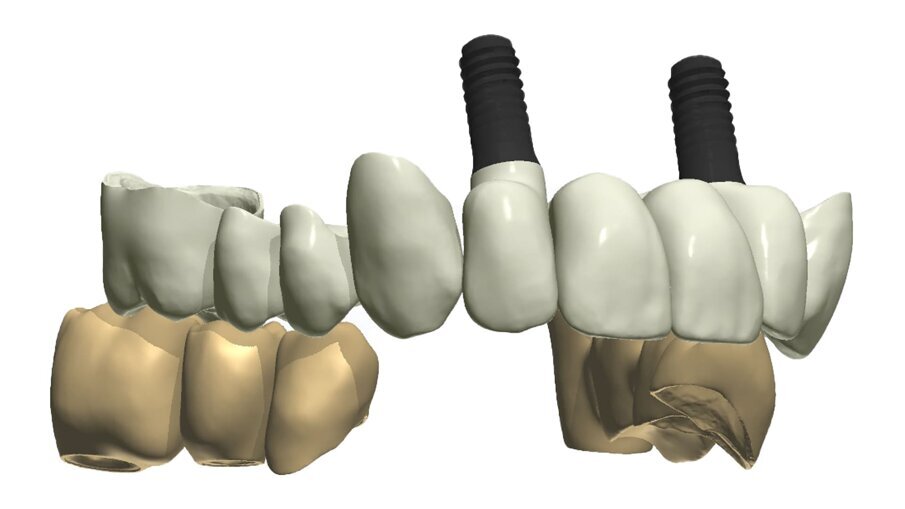 Fig. 37_La medesima immagine viene sottratta dagli elementi di supporto. Tale visione consente di evidenziare i margini coronali, di valutare i movimenti masticatori, gli svincoli coronali le conformazioni anatomiche ottimizzando le singole funzioni.