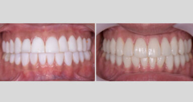 ¿Dientes blancos?