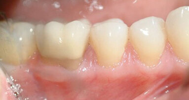Novel approach to gingival grafting: Single-stage augmentation graft for root coverage