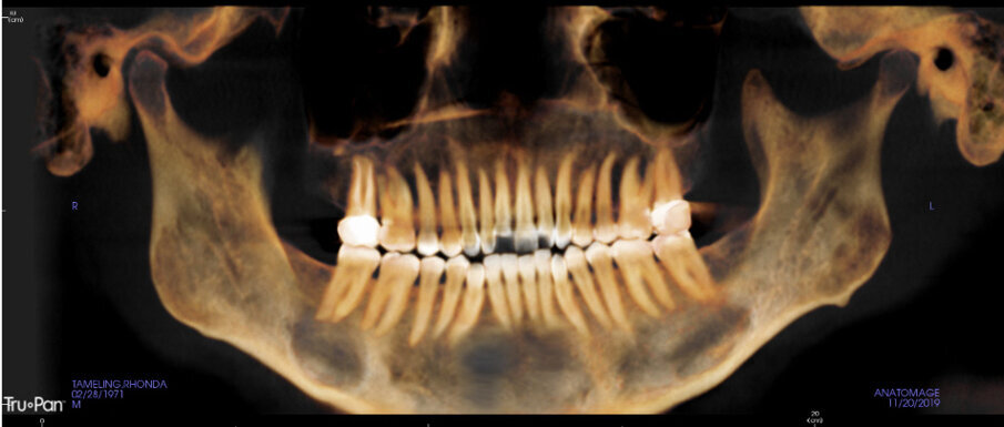 Pre-treatment