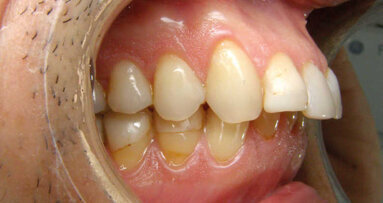 Les aligneurs en orthodontie : une solution à la portée de l’omnipraticien