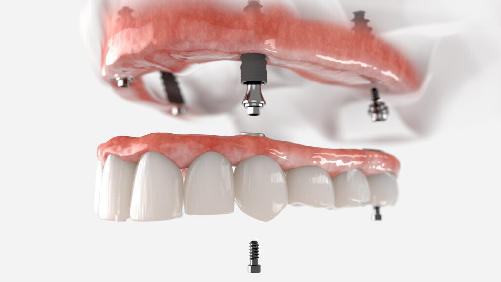 Preferences for fixed restorations and resulting impact on the US and European overdenture markets