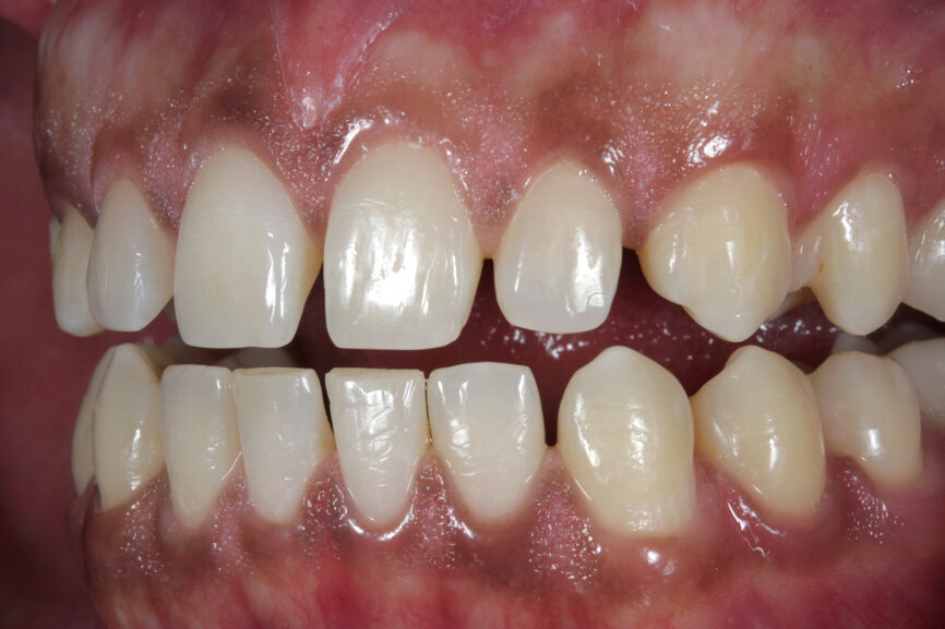 Fig. 3: Initial situation with diastemas in the upper and lower jaws.