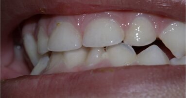 Treating Incipient Dental Caries In Children, A New Method Developed
