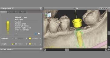 La biblioteca de implantes de Neodent disponible con el software coDiagnostiX