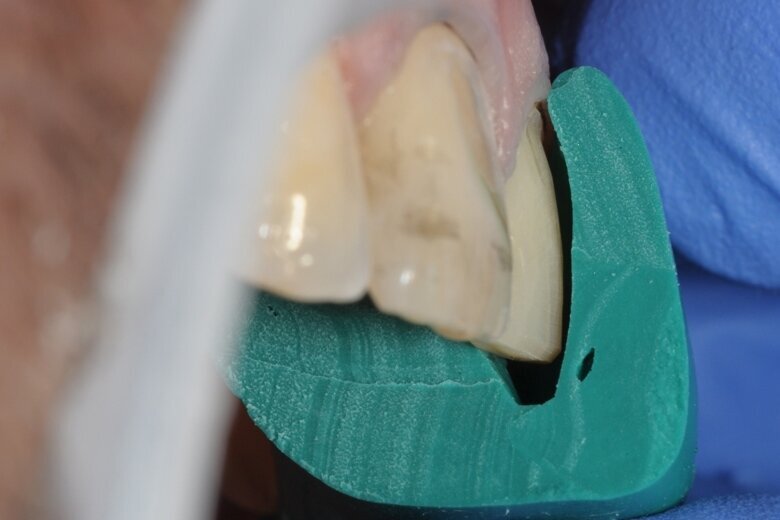Fig. 4 Checking the space using a silicone mould.