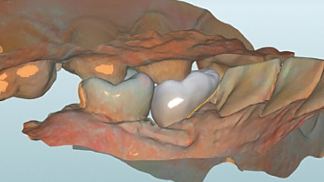 Fig. 9. Vista lingual del diseño.