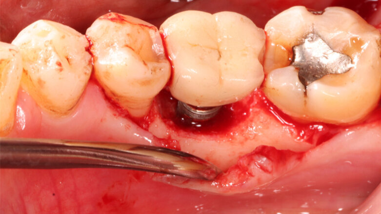 Discovery months: Neodent presents three dental implant education highlights