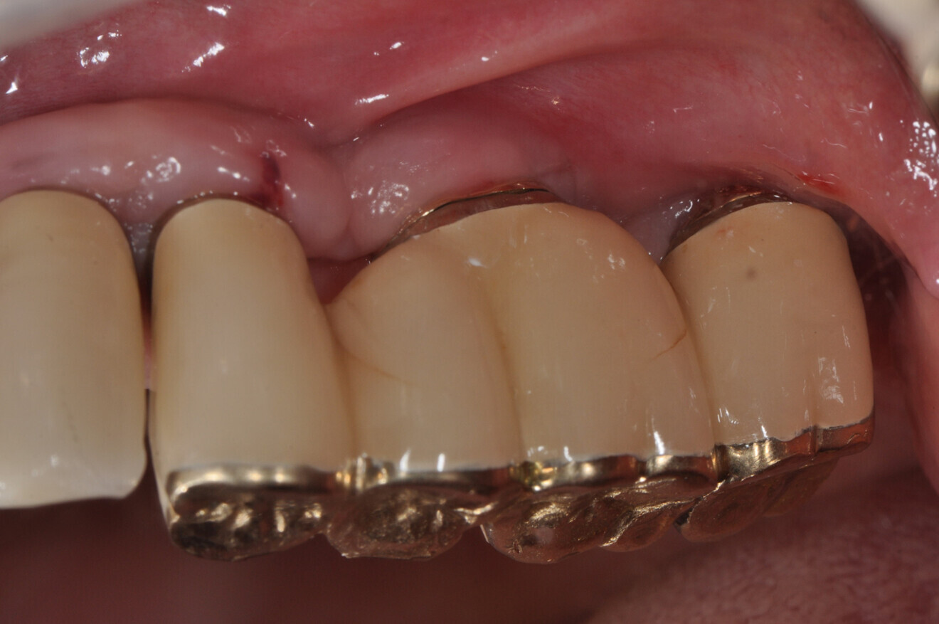 Improvement one week after periodontal treatment.
