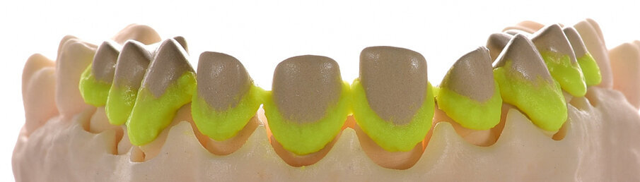Fig. 6 & 7: Application of the ceramic margin using the Margin materials of the two ceramic systems (left: IPS d.SIGN; right: IPS Style)