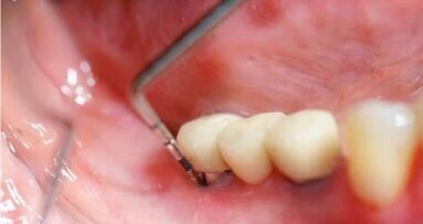 Zastosowanie laserów w leczeniu periimplantitis – przegląd piśmiennictwa