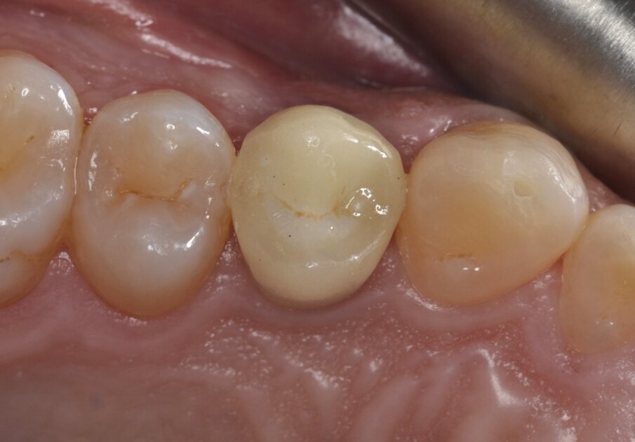 Fig. 24 - Corona protesica definitiva in zirconia stratificata (visione occlusale).